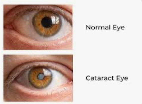 WHAT IS A CATARACT?